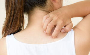 Huidproblemen onder de loep: wat te doen bij netelroos