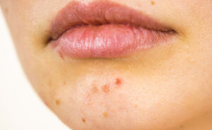 Dit is hoe je littekens van acne kunt laten verwijderen