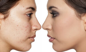 Dit zijn de meest effectieve manieren om van acne af te komen 