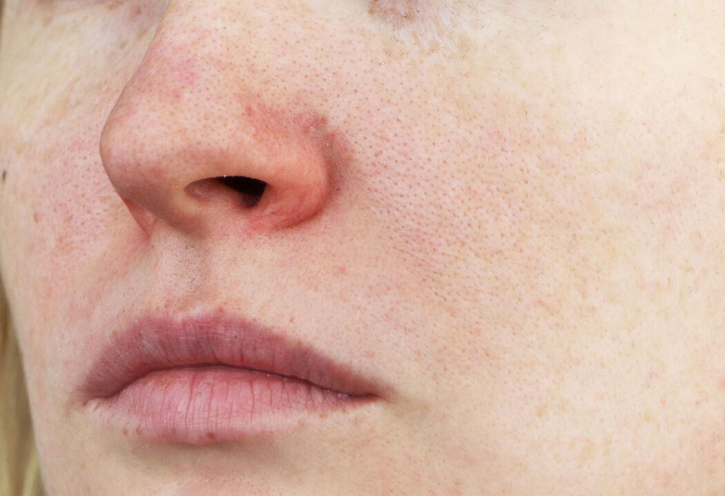 Dit is rosacea en zo kom je er vanaf