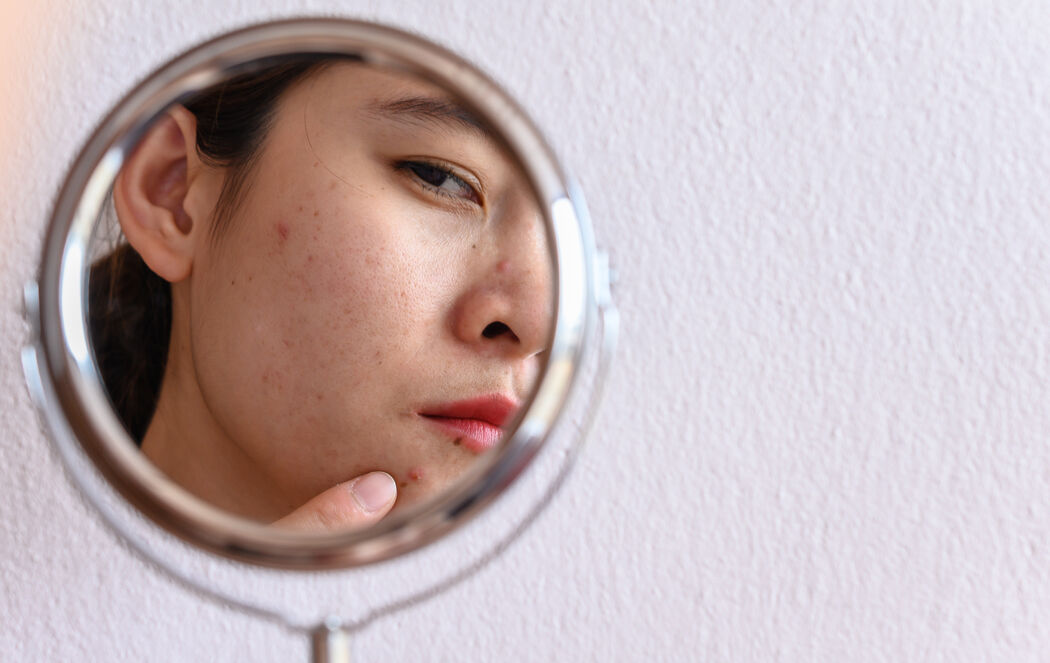 Acne positivity: 5 influencers met een acnehuid om te volgen op instagram