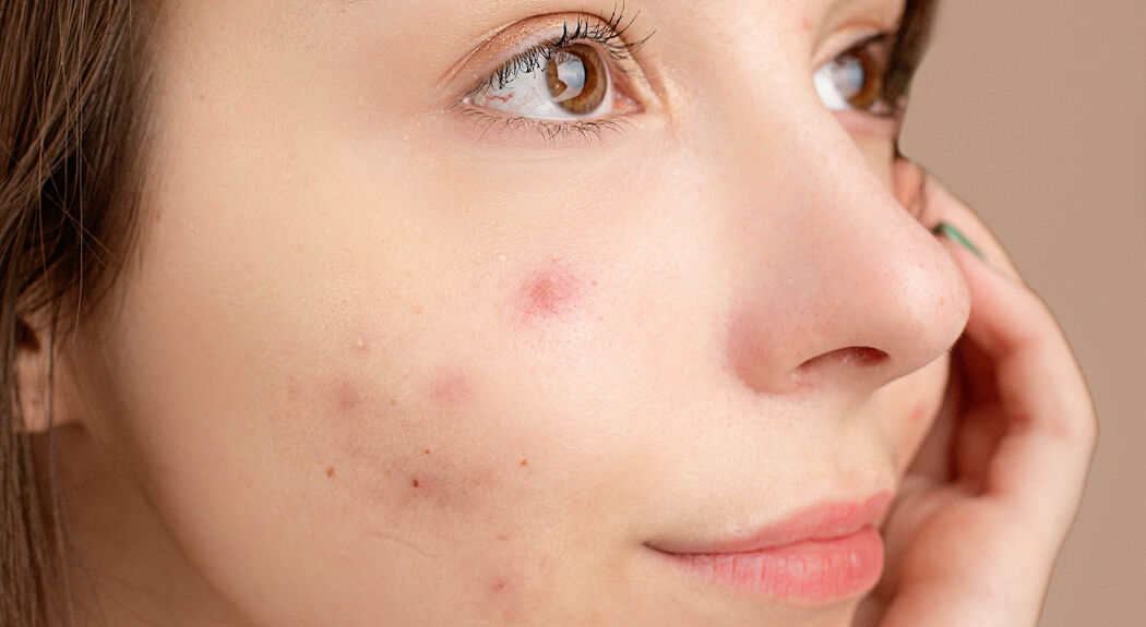 Is anti-roos shampoo hét nieuwste beautyproduct tegen acne?