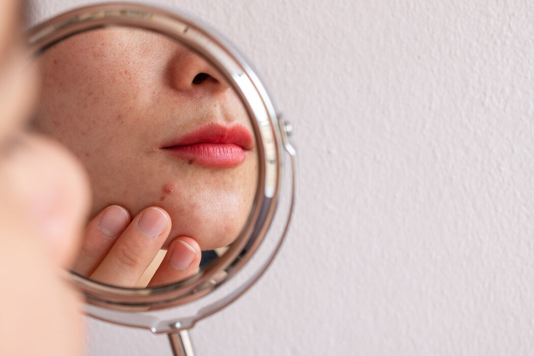 Wat is fungal acne en hoe kom je ervan af?