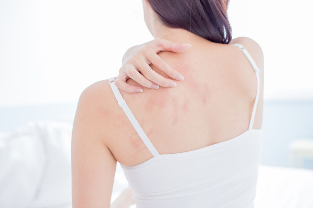 Last van acne op je rug? Zo kom je ervan af