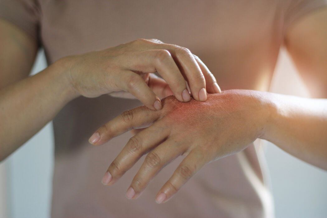 Losse velletjes op je handen: dit kun je eraan doen