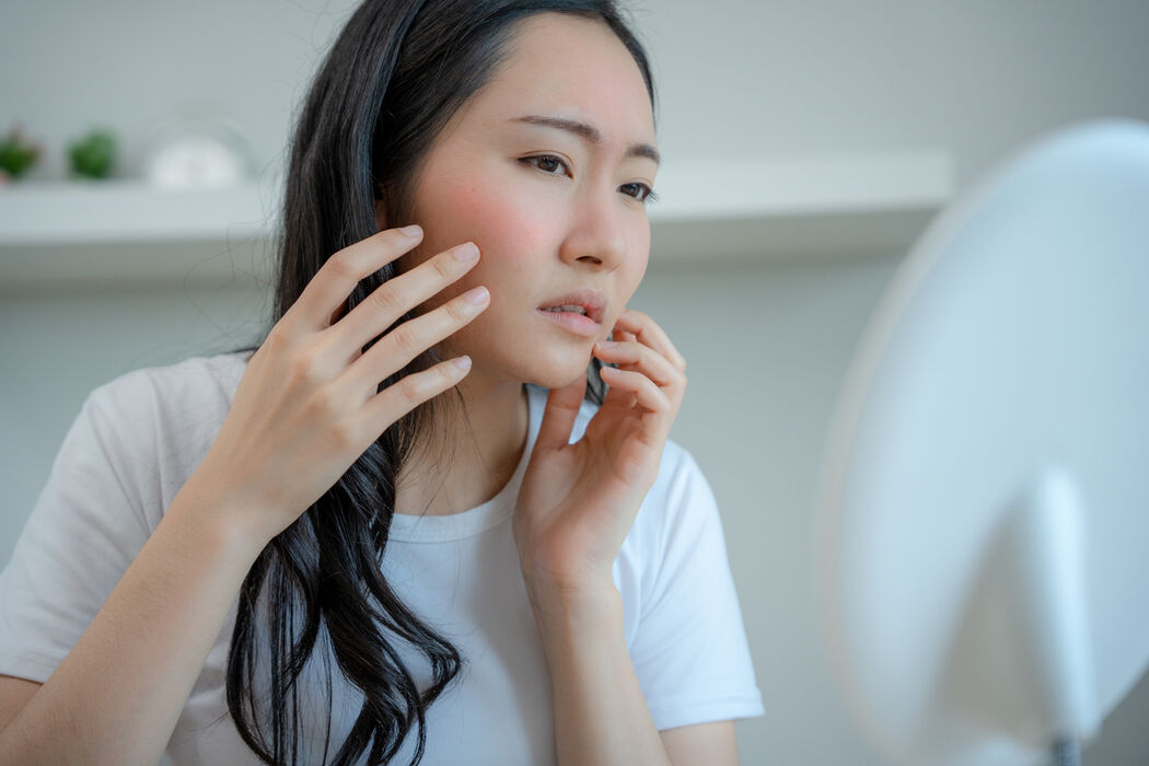 Skin tag laten verwijderen? Dit moet je erover weten